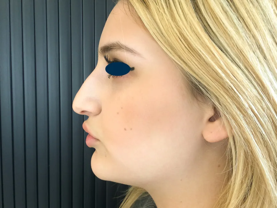 Photo avant rhinoplastie - Dr Pulvermacker, Paris