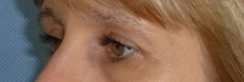 Résultat chirurgie des paupières - Dr Pulvermacker, Paris